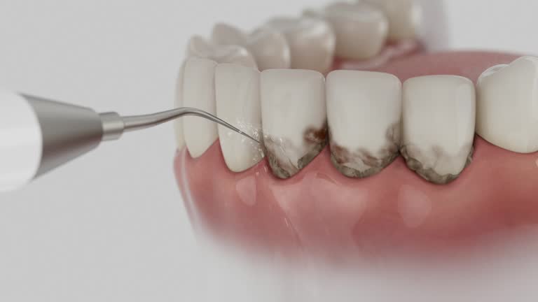 Reliable Wisdom Tooth Removal contractor in Bakersfield, CA by Smile Center Dentistry